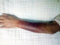 六旬老太在家使用天然气被烧伤