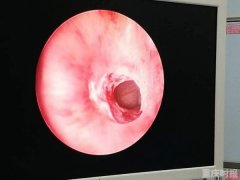 2个月婴儿先天鼻孔闭锁 这台手术如绣花